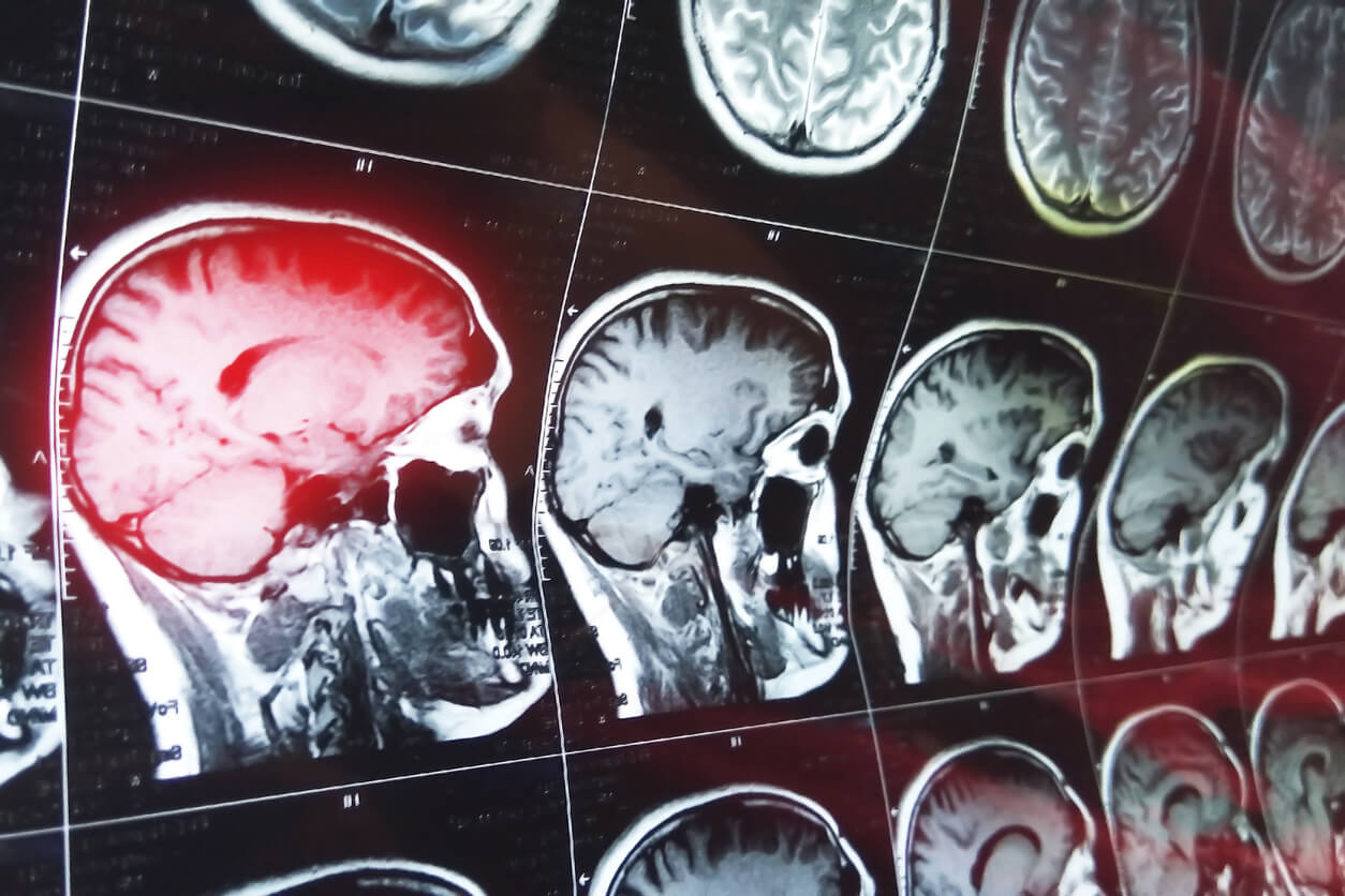 Empowering Knowledge: understanding Stroke and the Path to Neurological Rehabilitation